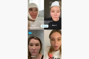 Катя Конасова поделилась фото после пластики в Instagram и раскрыла детали katya konasova podelilas foto posle plastiki v i raskryla detali-lessontime-ru-0