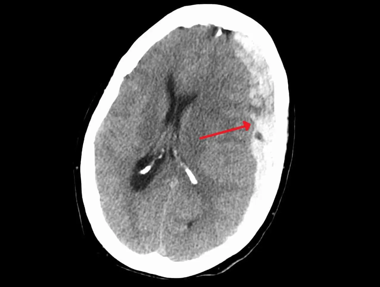 Новые подходы к оценке исходов травматической субдуральной гематомы в ПГМУ имени Е.А. Вагнера-0