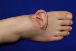 Китайские врачи из Цзинаня вернули женщине ухо после уникальной операции kitajskie vrachi iz czzinanya vernuli zhenshhine uho posle unikalnoj operaczii-lessontime-ru-0