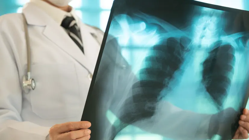 Россиянам назвали тревожные сигналы, которые могут указывать на туберкулёз