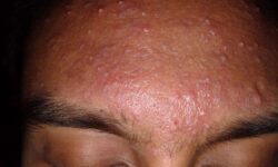 Акне теперь можно победить инновационными методами света и плазмы akne teper mozhno pobedit innovaczionnymi metodami sveta i plazmy-ul-rks-ru-174120061500-0