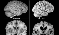 Длительный прием популярных препаратов открывает новые перспективы в профилактике когнитивных расстройств dlitelnyj priem populyarnyh preparatov otkryvaet novye perspektivy v profilaktike kognitivnyh rasstrojstv-ul-rks-ru-174161498500-0