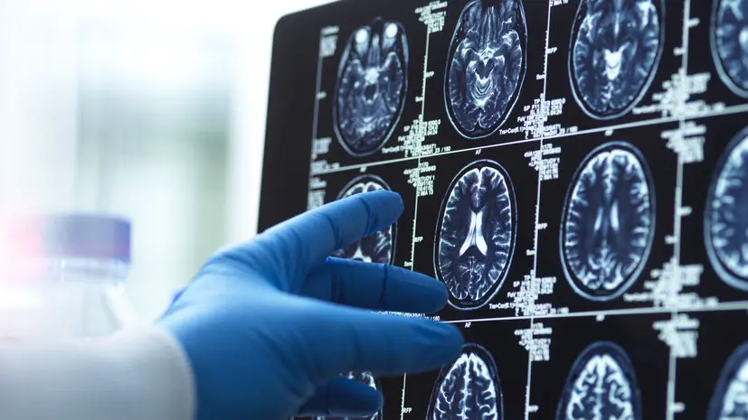 Невролог Демьяновская рассказала, как развивается деменция у человека