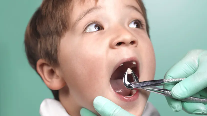 Врач рассказал о последствиях преждевременного удаления молочных зубов