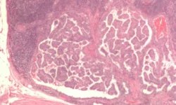 Петр Трусов и Нина Зайцева из ПНИПУ о возрастных рисках онкологии petr trusov i nina zajczeva iz pnipu o vozrastnyh riskah onkologii-ul-rks-ru-0