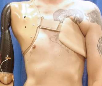 Роботизированное протезирование дает полноценные руки