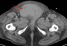 Медицинский центр UTHSC и Университет Теннесси сообщают о редком случае разрыва яичка из-за сердечных осложнений mediczinskij czentr i universitet tennessi soobshhayut o redkom sluchae razryva yaichka izza serdechnyh oslozhnenij-ekaterinburgu-ru-174401722500-0