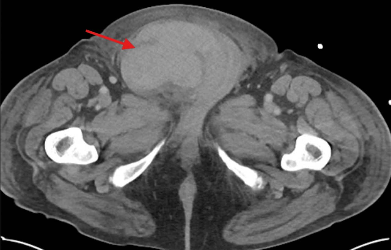 Медицинский центр UTHSC и Университет Теннесси сообщают о редком случае разрыва яичка из-за сердечных осложнений-0