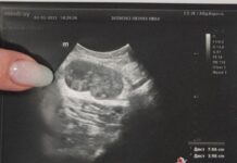 unikalnyj sluchaj v czgkb 3 metastaz bez pervichnoj opuholi u paczienta-ekaterinburgu-ru-174487855100-0