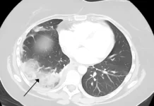 Сеченовский университет представляет коллагеновую пластину и биологический клей sechenovskij universitet predstavlyaet kollagenovuyu plastinu i biologicheskij klej-ekaterinburgu-ru-0