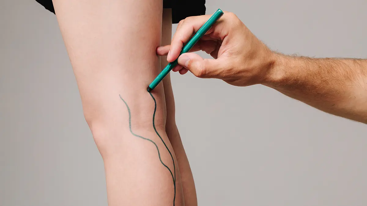 Почему возникает венозная недостаточность