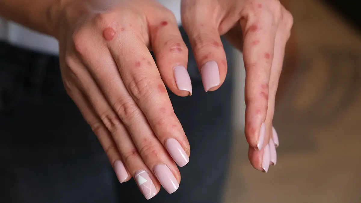 Заслуженный врач Осипов высказался о вспышке вируса Коксаки в России