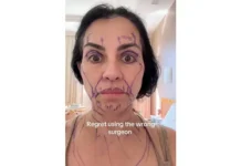 Вера Шагас рассказала о своей неудачной пластической операции vera shagas rasskazala o svoej neudachnoj plasticheskoj operaczii-ekaterinburgu-ru-0