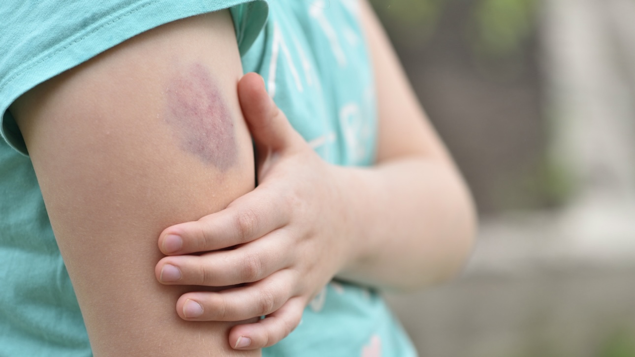 Поливала кипятком: мальчик из Видного рассказал об ужасах, которые творились дома