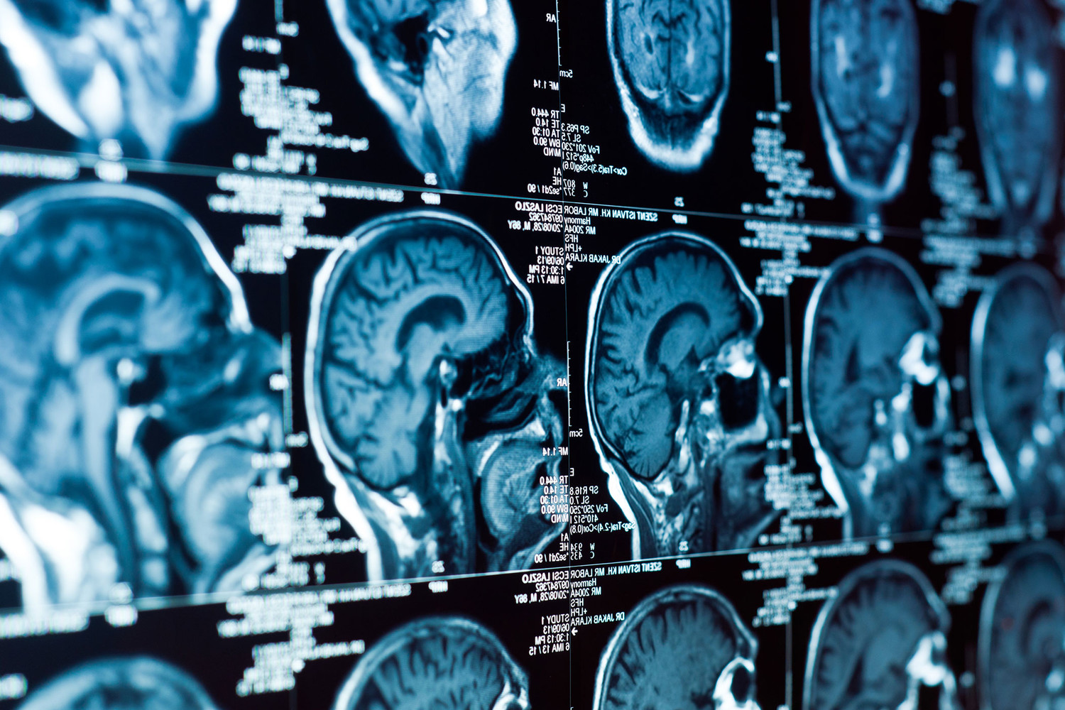 Открытие С. Томаса Кармайкла и Мин Тянь в UCLA Health вселяет надежду на лечение деменции-0