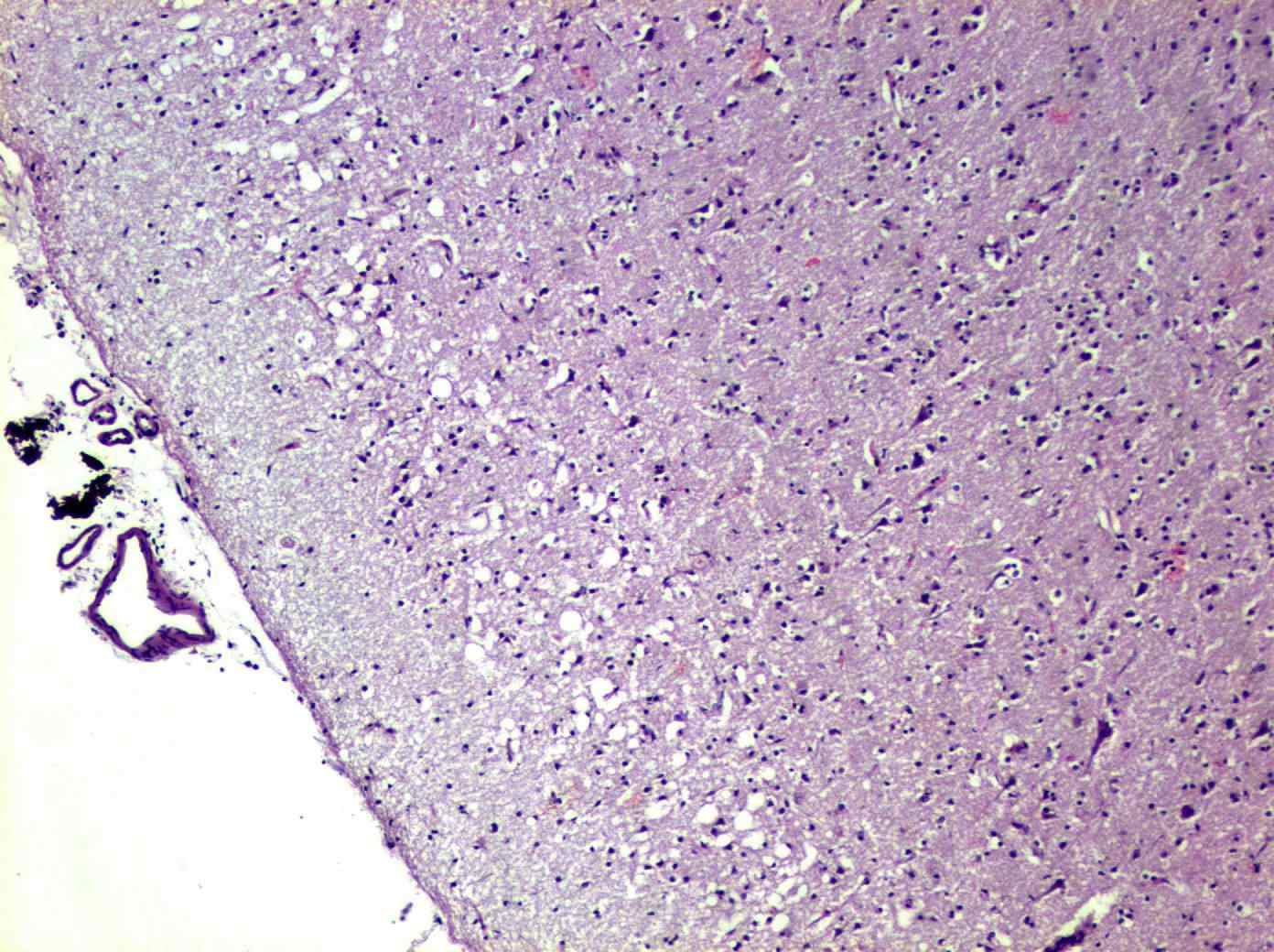 Ученые ПГМУ имени Вагнера и РНФ добились успехов в исследовании болезни Пика в Перми-0