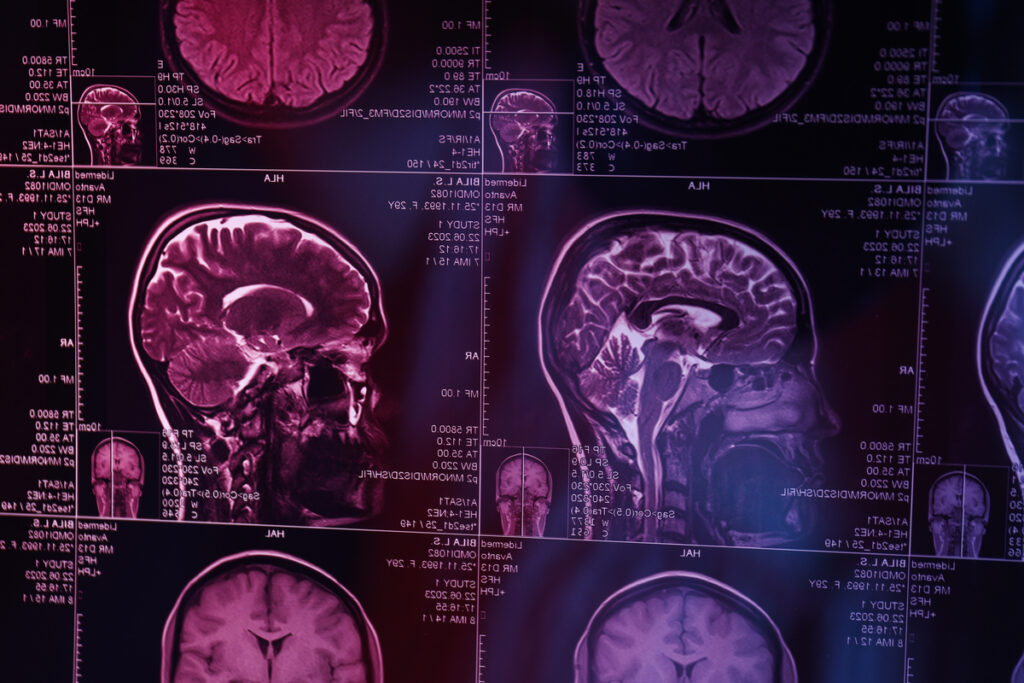 МРТ головы и мозга