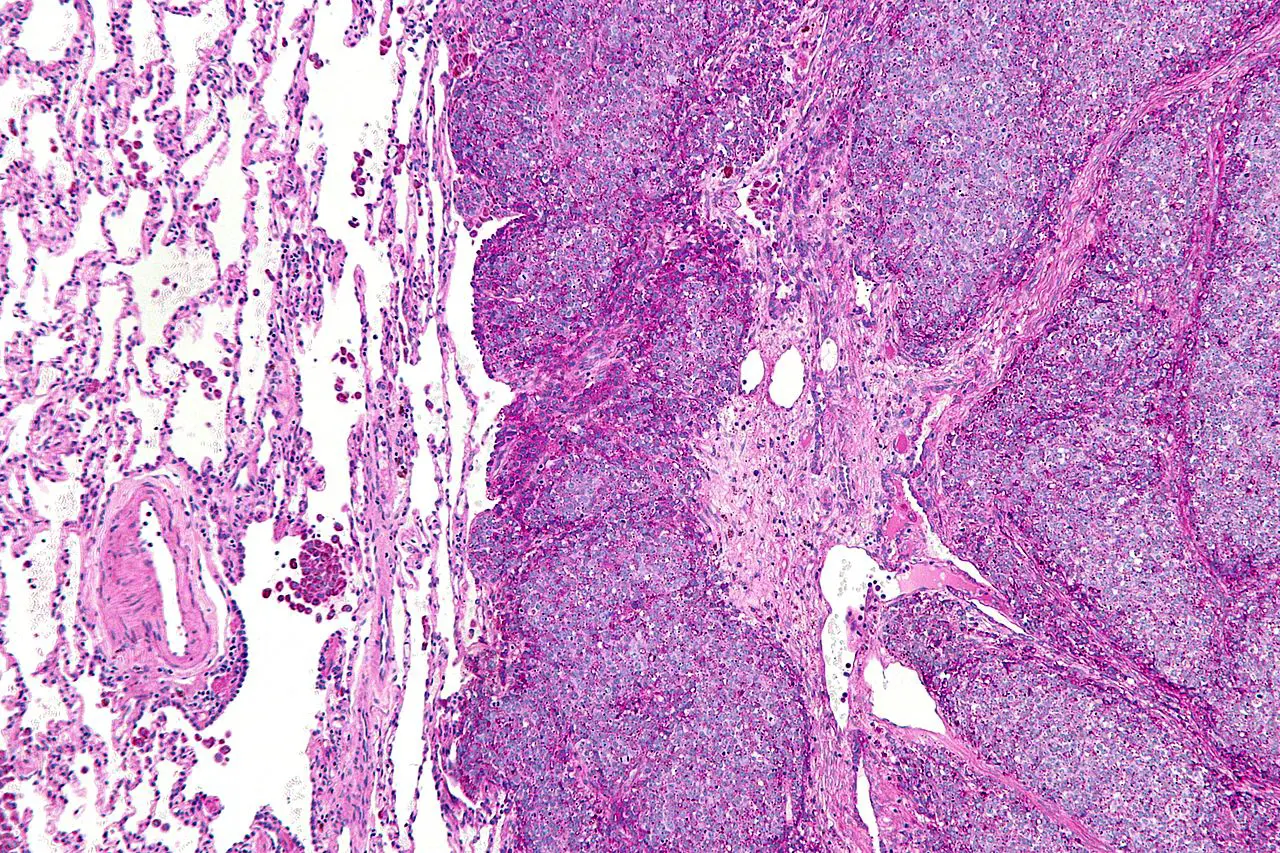 Институт Биологии Гена РАН и Сеченовский Университет открыли новые пути лечения саркомы Юинга-0