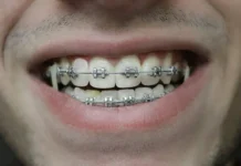 zumery eksperimentiruyut s breketami superkleem i -pux-su-0