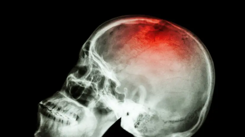 Врач Шарипова: риск инсульта максимально высок после 60 лет