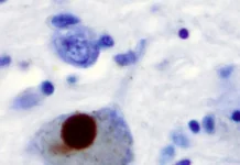 МГУ: фрагменты прионного белка открывают пути против нейродегенераций mgu fragmenty prionnogo belka otkryvayut puti protiv nejrodegeneraczij-journalrf-ru-0