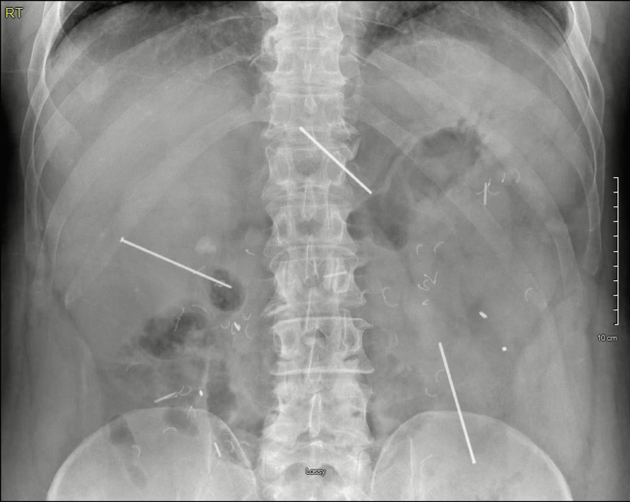 Государственный университет Восточного Теннесси представляет уникальный случай спасения пациента-0