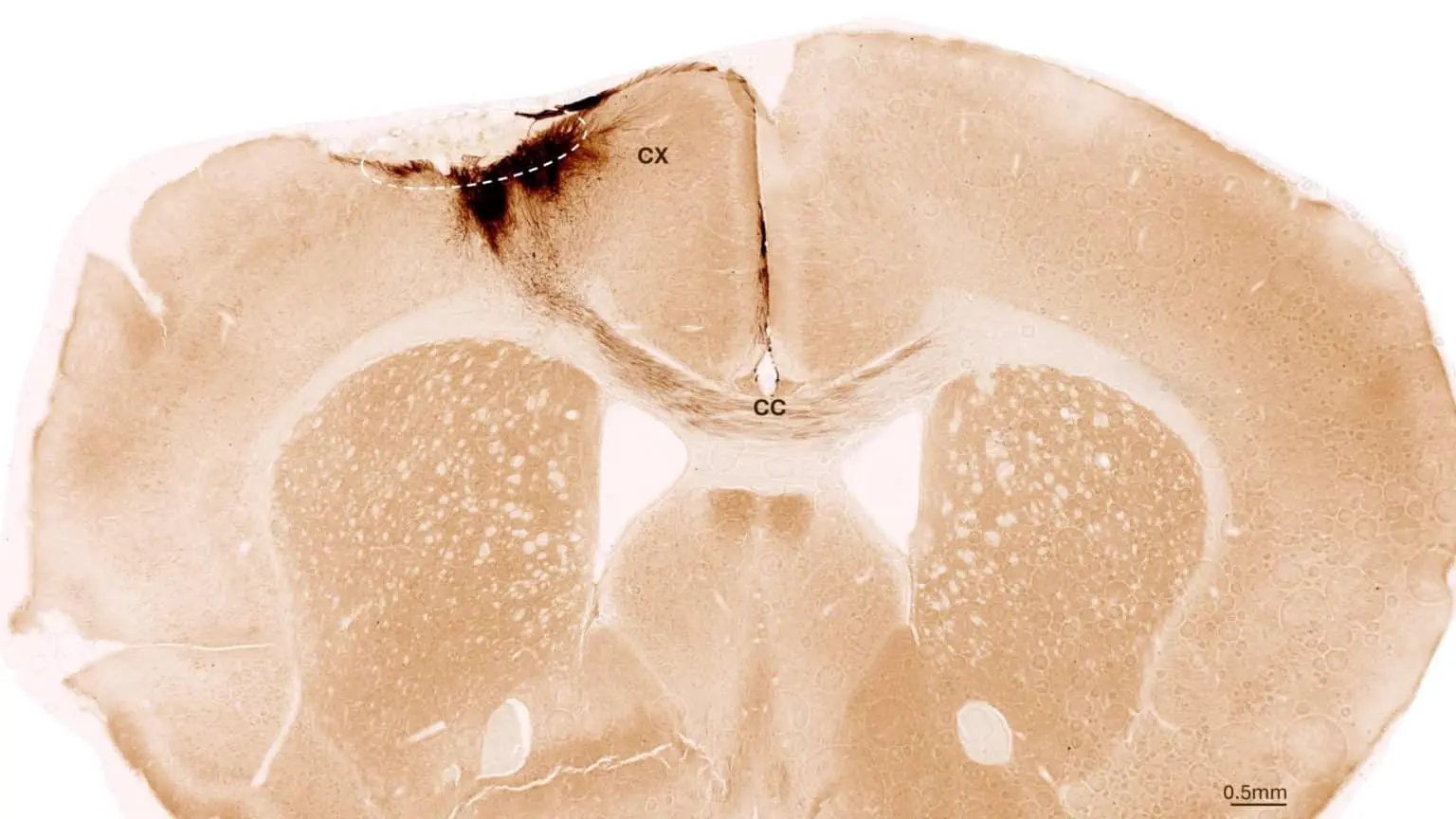 Стволовые клетки восстанавливают мозг при лечении инсульта-0