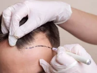 Британец выбрал Стамбул для медицинского туризма с пересадкой волос и стоматологией britanecz vybral stambul dlya mediczinskogo turizma s peresadkoj volos i stomatologiej-lavi-su-0