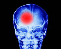 Юлия Маршинцева из Москвы раскрыла связь микроинсульта и временной потери зрения yuliya marshinczeva iz moskvy raskryla svyaz mikroinsulta i vremennoj poteri zreniya-signaldaily-ru-174237933500-0