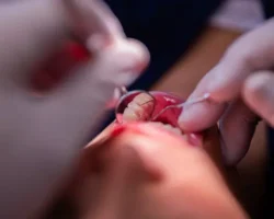 Университет Ноттингема создал уникальный белковый гель для восстановления эмали и дентина universitet nottingema sozdal unikalnyj belkovyj gel dlya vosstanovleniya emali i dentina-signaldaily-ru-0