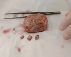 В Балаковской городской клинической больнице проведена уникальная операция v balakovskoj gorodskoj klinicheskoj bolnicze provedena unikalnaya operacziya-signaldaily-ru-0