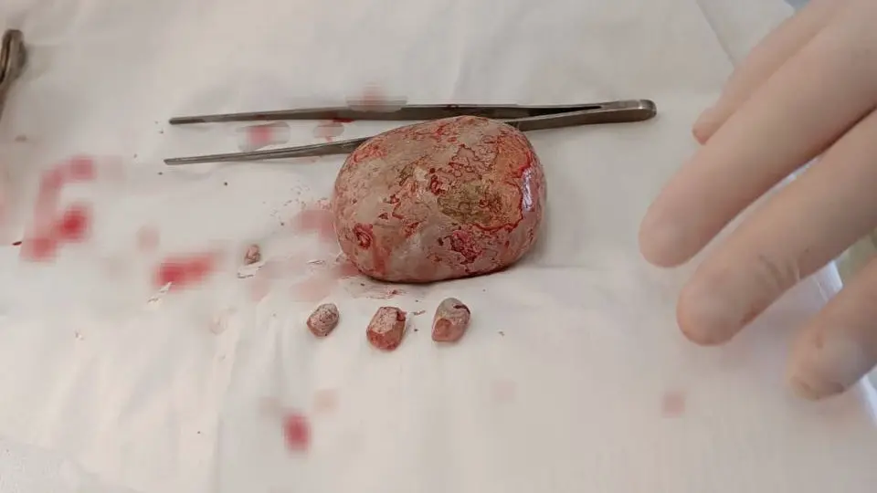 Врачи в Балаково извлекли килограммовый камень из мочевого пузыря пациента