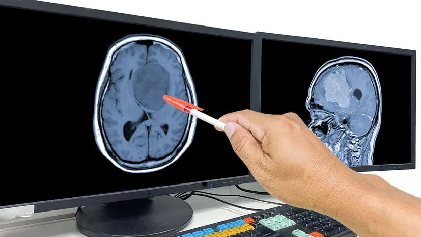 Онколог Черёмушкин рассказал о симптомах глиобластомы