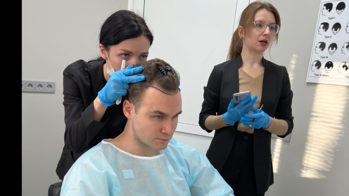 Блогер Николай Соболев сделал пересадку волос на ранней стадии алопеции