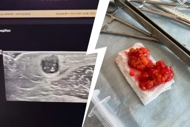 У женщины вырезали сразу два образования | Источник: Московская медицина / Telegram