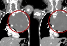Как врачи РДКБ Минздрава России спасли девочку с ганглионейробластомой kak vrachi rdkb minzdrava rossii spasli devochku s ganglionejroblastomoj-onlymainnews-ru-0