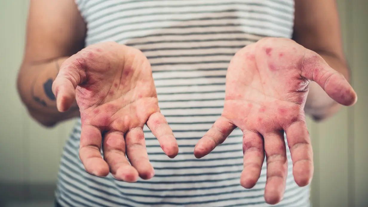 Эпидемиолог Альтштейн предупредил об эпидемии ветрянки в России