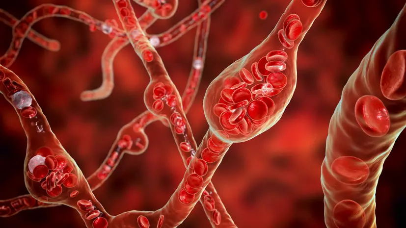 Хирург Григорьян: аневризма может образоваться в любом сосуде