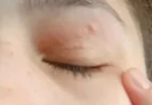 В Румынии девушке удалили червя Dirofilaria repens из глаза после укуса комара v rumynii devushke udalili chervya iz glaza posle ukusa komara-onlymainnews-ru-0