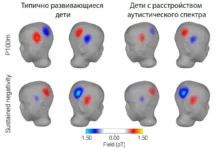 mgppu i rnf izuchili svyaz sluhovoj kory autizma i rechi-onlymainnews-ru-0
