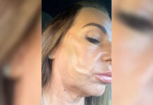 Пациентка нашла выход из сложной ситуации после неудачной косметической процедуры 77e14811-dd68-48c1-aadb-092f1cd1b00a-67fff40e