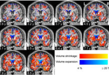 Прорыв в изучении болезни Паркинсона и гендерных различий proryv v izuchenii bolezni parkinsona i gendernyh razlichij-todey-ru-174061166800-0
