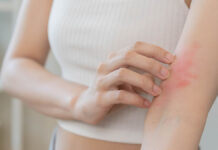 DermatologyAsianYoungWomanGirlAllergyAllergicReactionFromAtopic