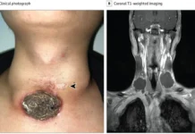 Удивительное исцеление в Сычуаньском университете рассказывает о победе над тату-патологией udivitelnoe isczelenie v sychuanskom universitete rasskazyvaet o pobede nad tatupatologiej-todey-ru-0