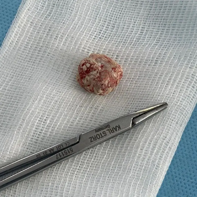 Врачи извлекли из слюнной железы жителя Владивостока камень, который тот "растил" 17 лет пресс-служба Минздрава Приморья