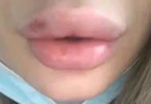 Аня Мао (yourani) меняет взгляды на красоту через Meta и филлеры anya mao menyaet vzglyady na krasotu cherez i fillery-todey-ru-0