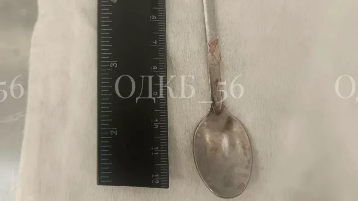 vrachi orenburga izvlekli lozhku dlinoj 14 sm iz gorla paczienta-todey-ru-0