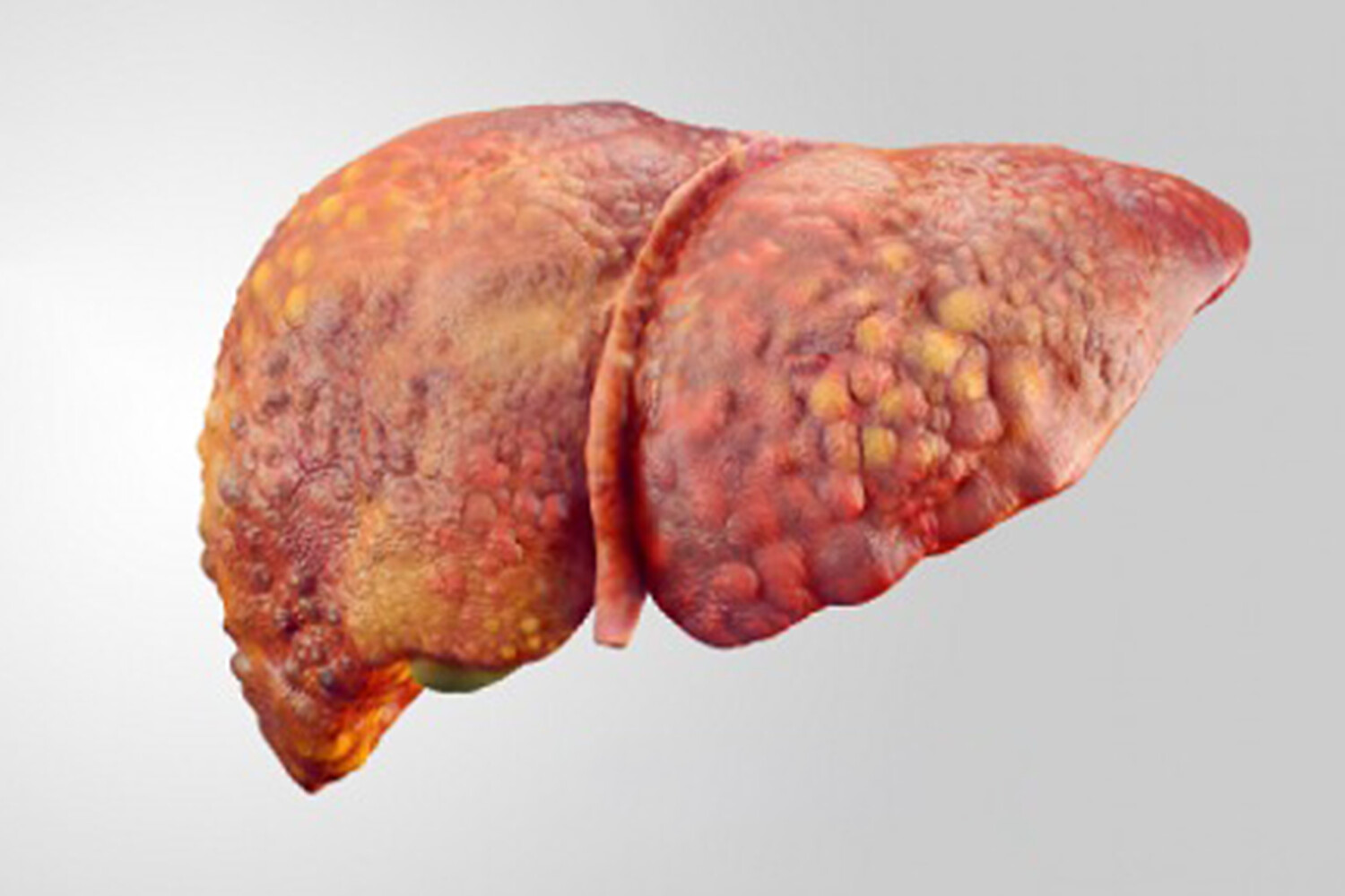 Ген Asah2 – новый шаг в профилактике жировой болезни печени-0