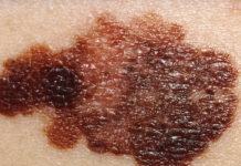 Оксана Зимина объясняет, как распознать опасные родинки и сохранить здоровье кожи oksana zimina obyasnyaet kak raspoznat opasnye rodinki i sohranit zdorove kozhi-obzone-su-174592870000-0