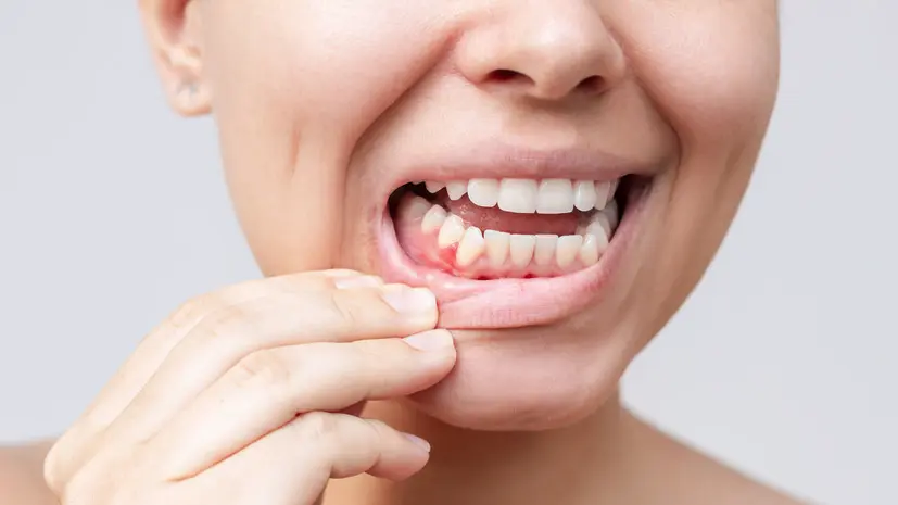 Стоматолог Харламова: из-за стресса могут развиться заболевания дёсен